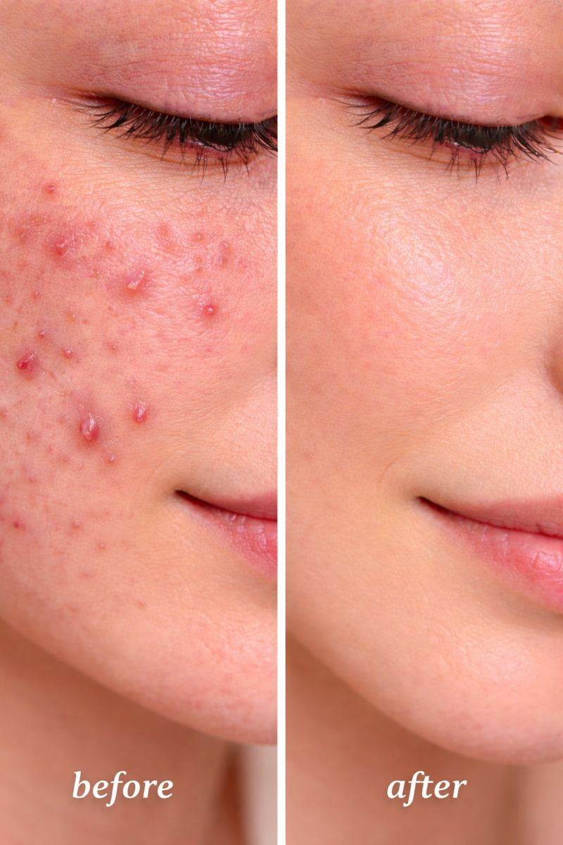 Blemish Routine (AM/PM)